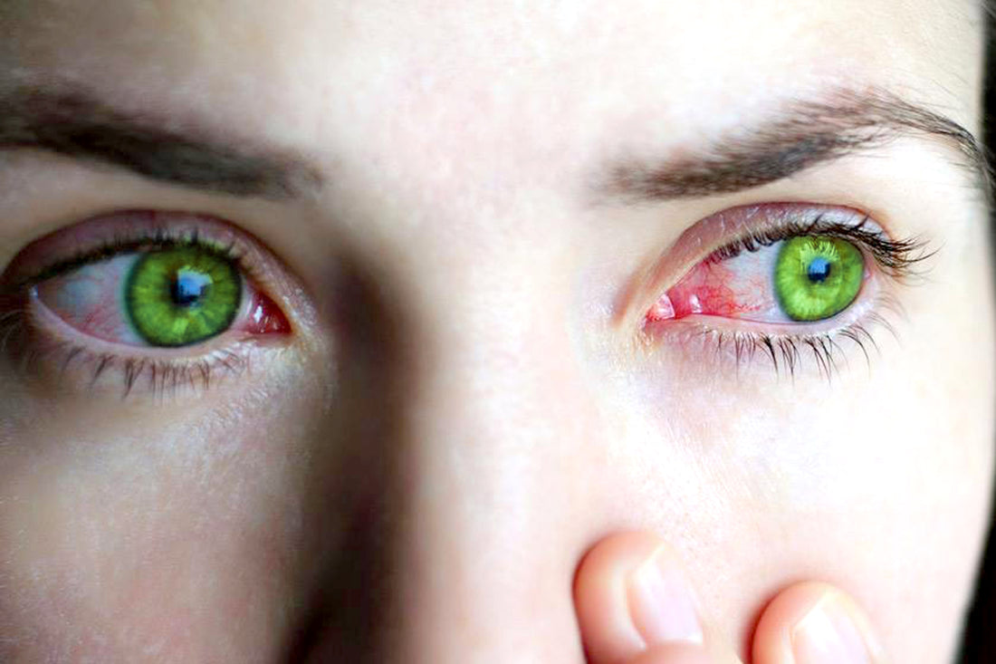 Woman with green red eyes due to irritation and having green cornea
